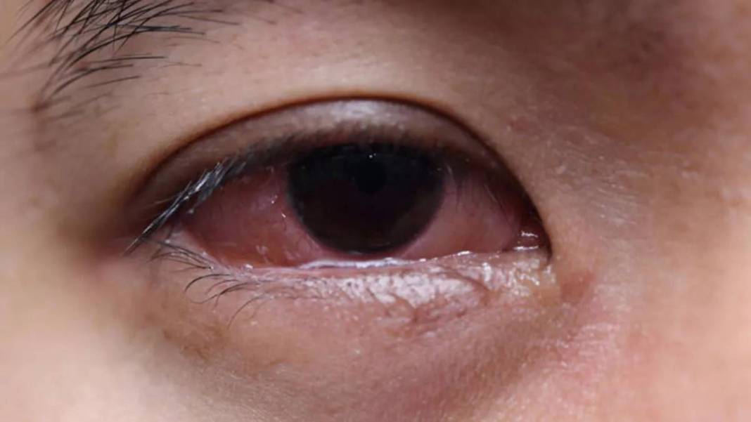 Bahar günlerinde gözünüzden olabilirsiniz! Bu belirtilere dikkat: Önce görme bozukluğuyla başlıyor 2